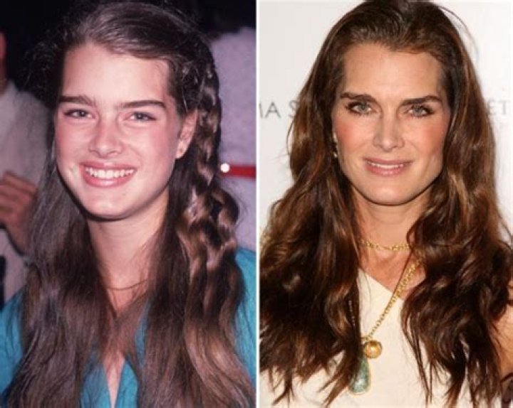 Brooke Shields Nose Job