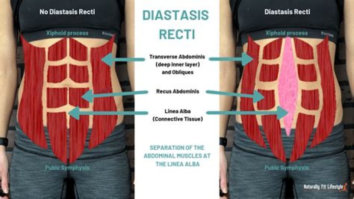 Can Diastasis Recti cause digestive problems?