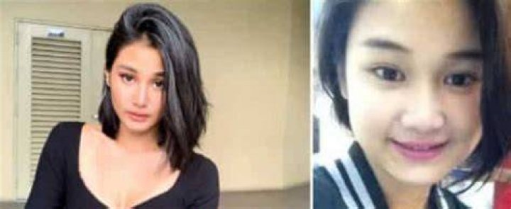 Chie Filomeno Plastic Surgery