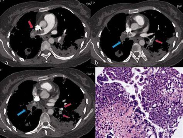 What is a filling defect in lung?